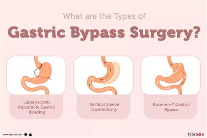 Are gastric bypasses safe?