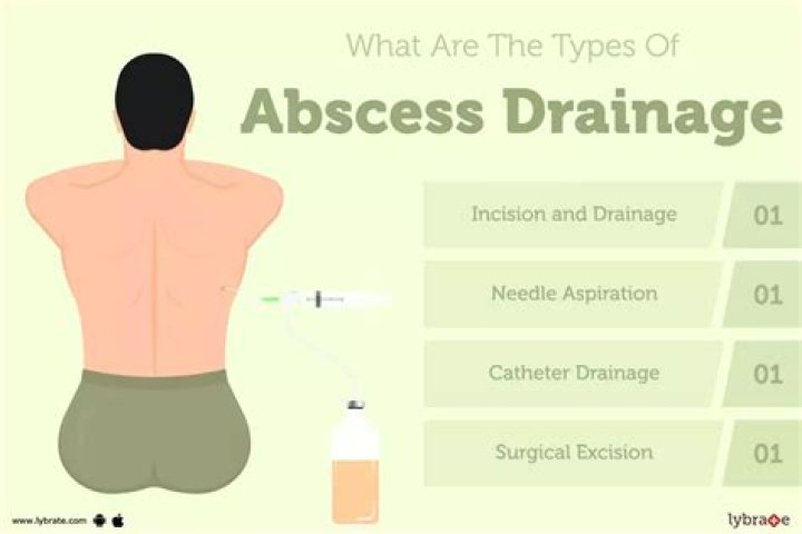 Can perianal abscess be treated without surgery?