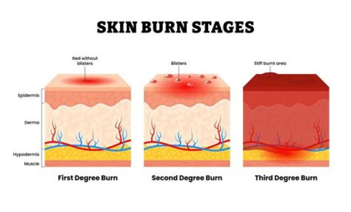 Can third degree burn scars be removed?
