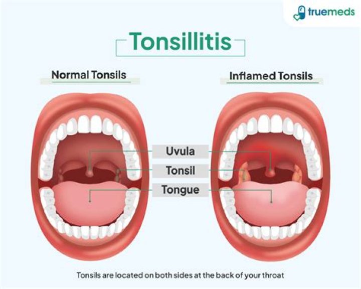 Could my tonsils be making me sick?