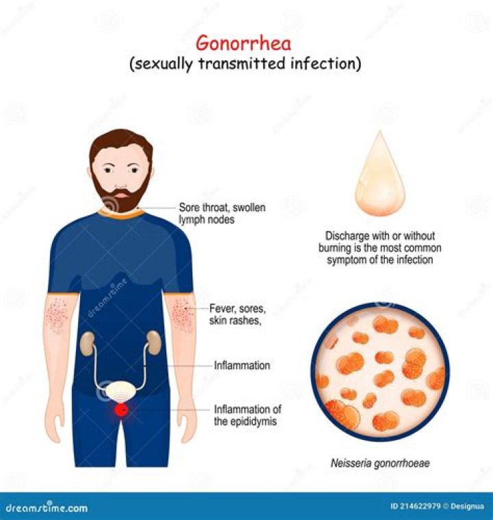 Could you have gonorrhea?