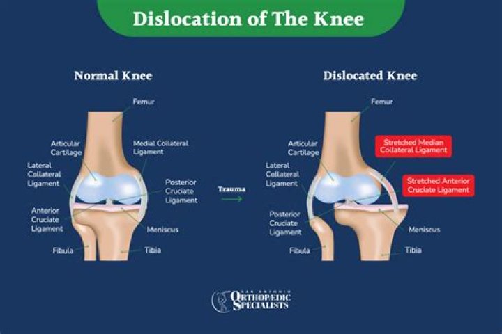 Did i just dislocated my knee?
