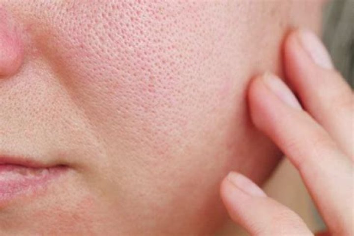 Do open pores close?