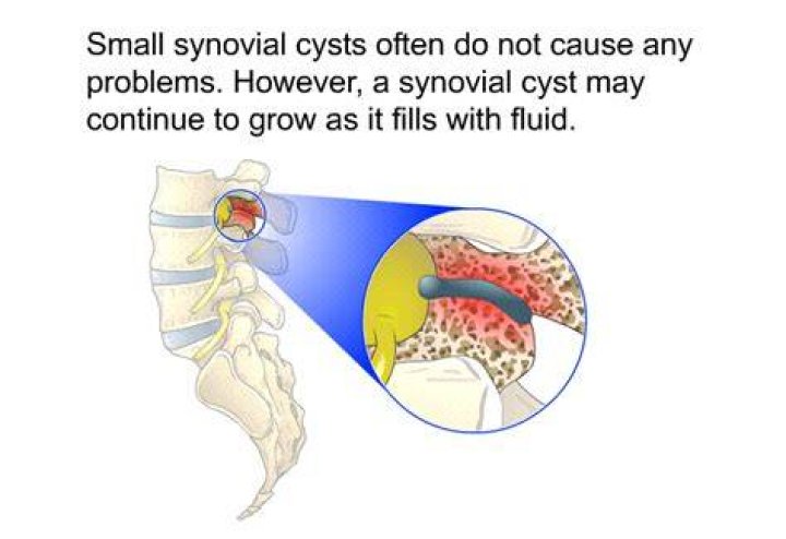 Do synovial cysts go away?