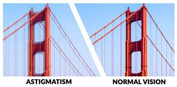 Does astigmatism cause double vision?