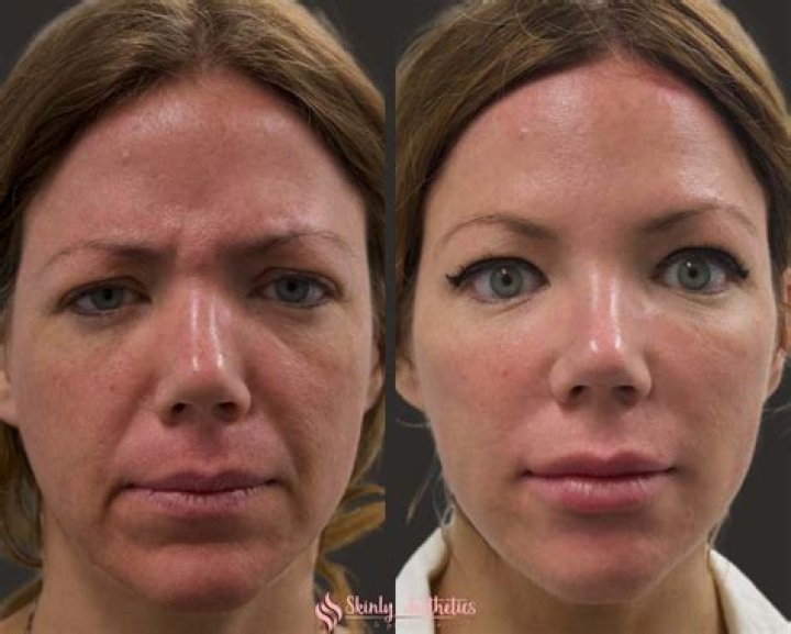 Does cheek filler hurt?