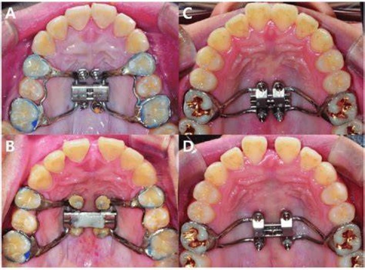 Does orthodontia include implants?