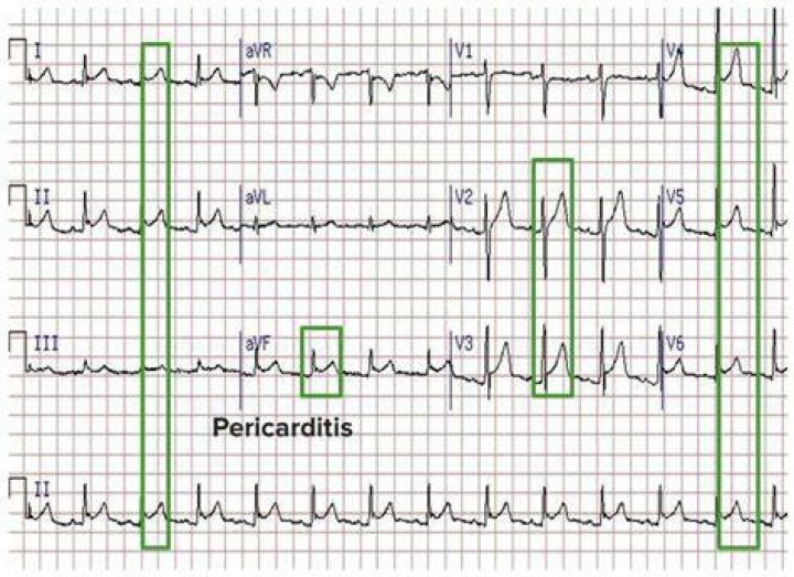 Does pericarditis show on ecg?