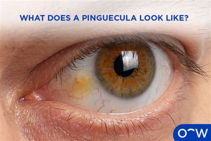 Does pinguecula affect vision?