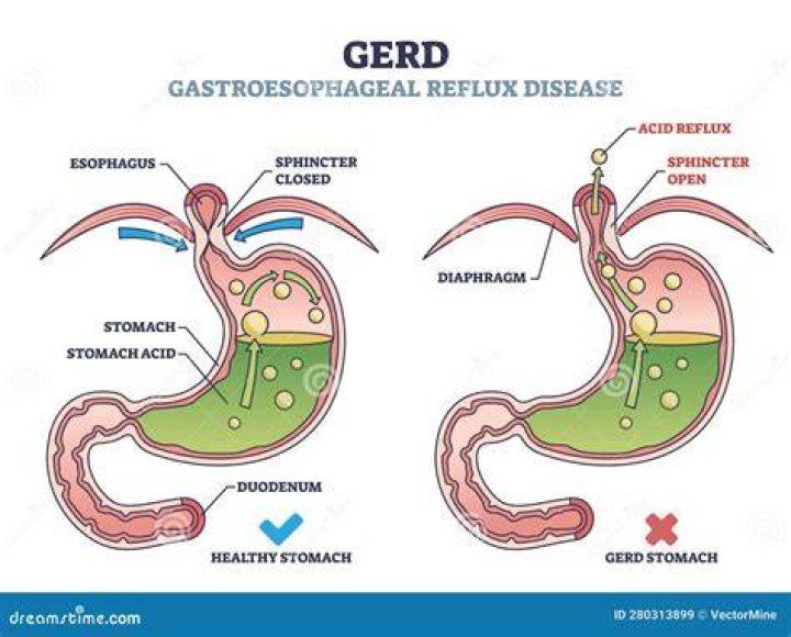Does regurgitation cause acid reflux?