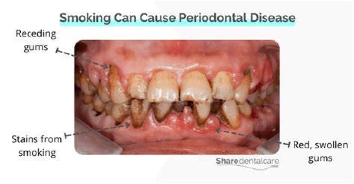 Does smoking cause periodontitis?