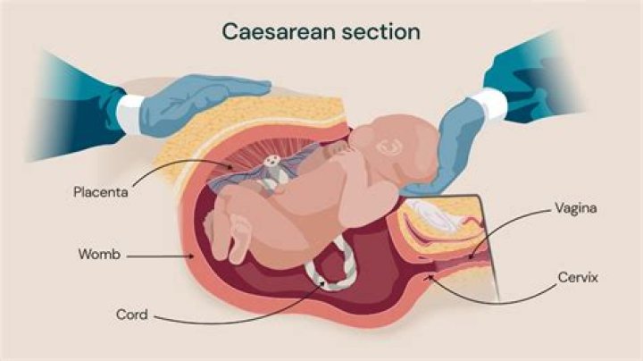 For elective caesarean section?