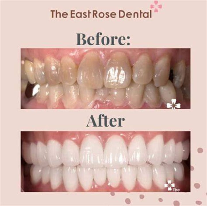 How painful is veneering?