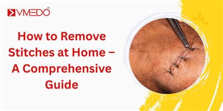 How stitches are removed?