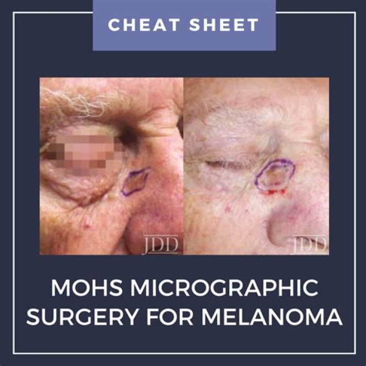 How to code mohs micrographic surgery?