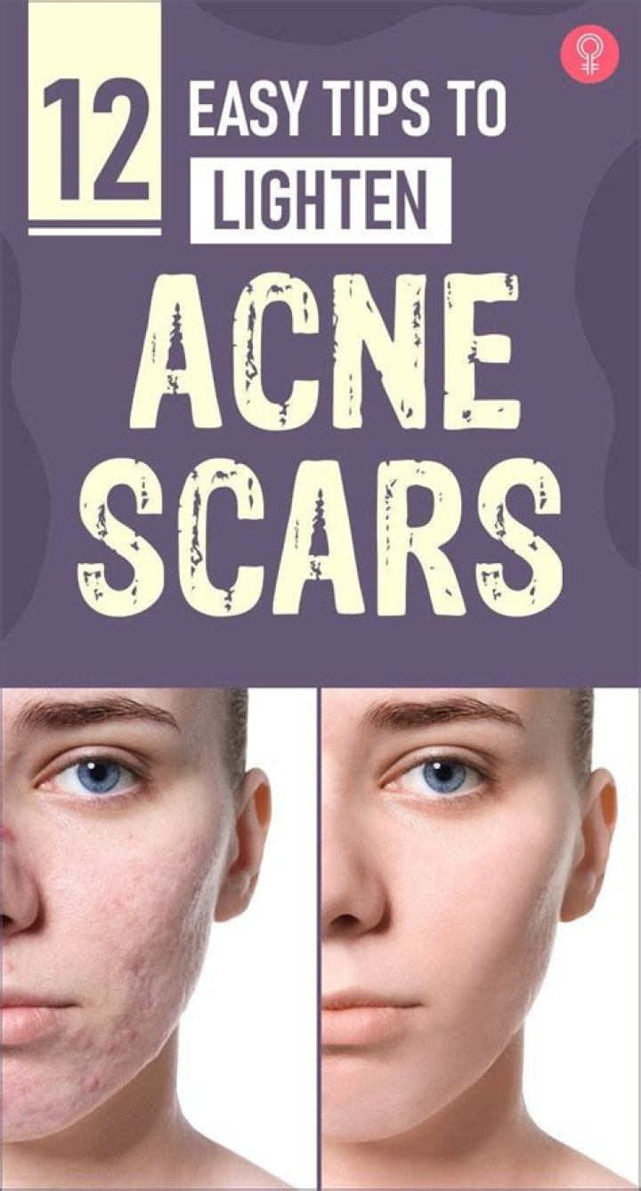 How to lighten back acne scars?
