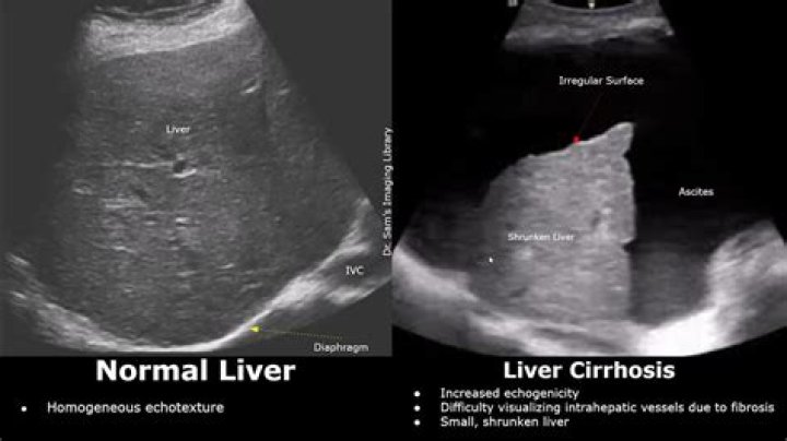 Is coarse liver reversible?