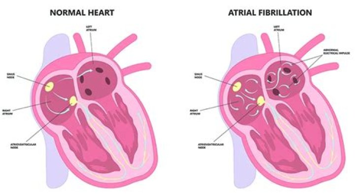 Is having afib dangerous?