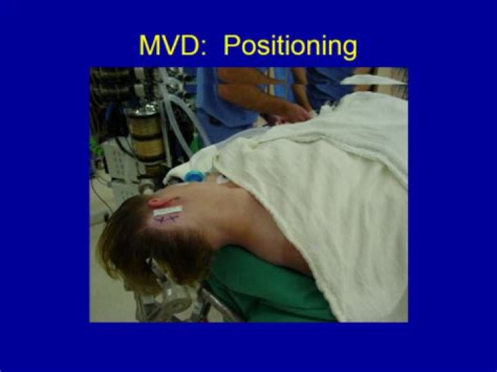 Is mvd brain surgery?