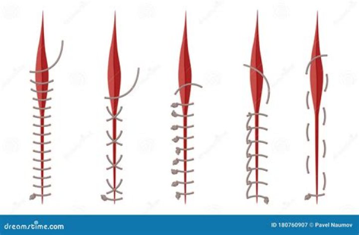 Is stitches considered surgery?