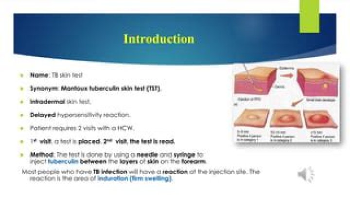 Is tb test intradermal?