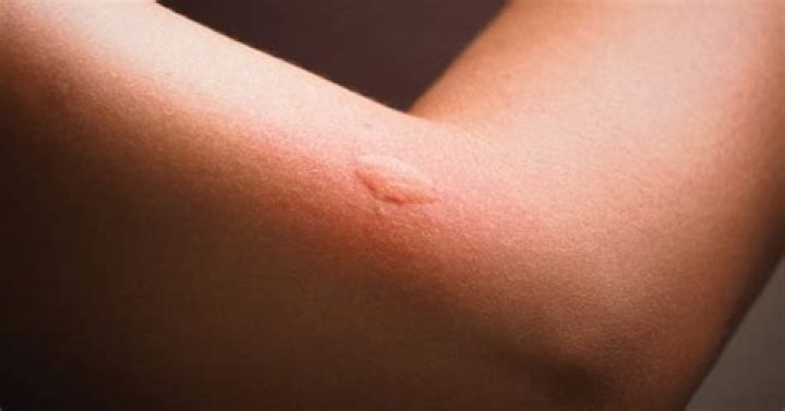 On a mosquito bite?