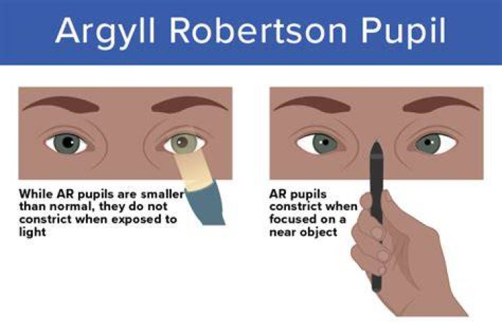 What causes argyll robertson pupil?