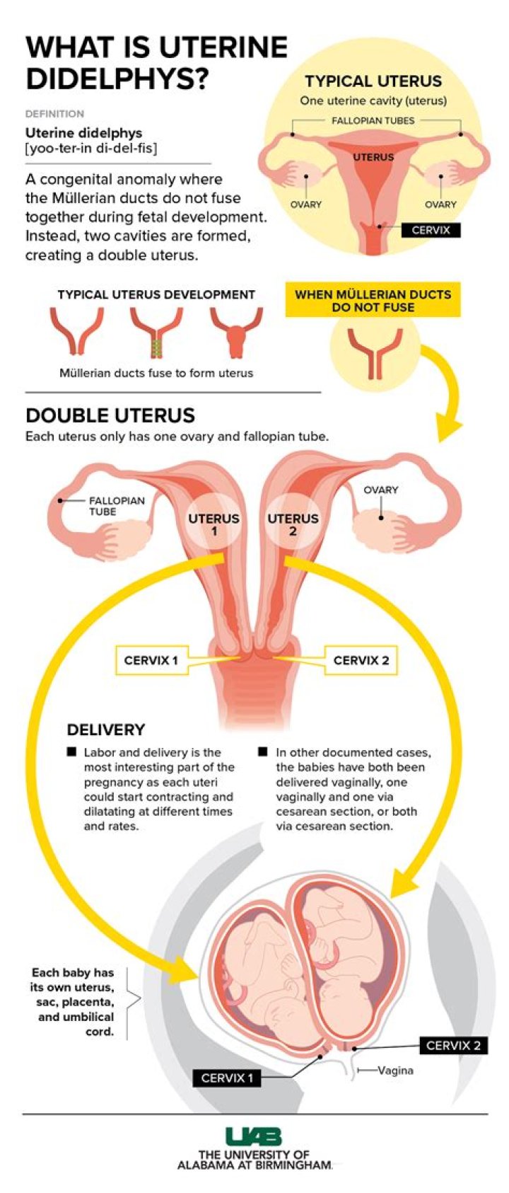 What causes uterus didelphys?