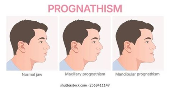What does prognathism mean?