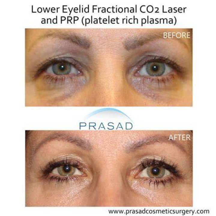 What injectable is used for under eyes?
