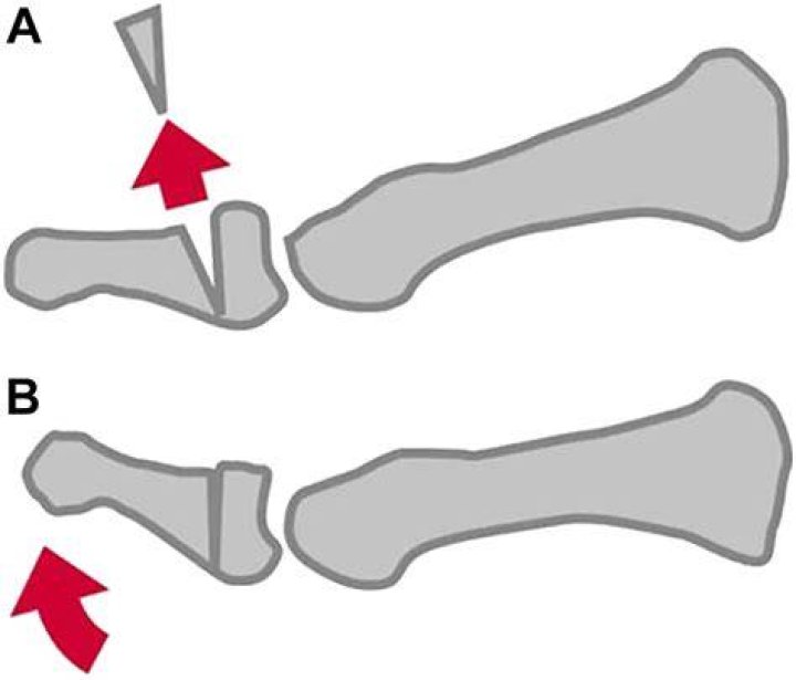 What is a moberg osteotomy?