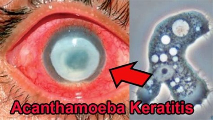 What is acanthamoeba keratitis?