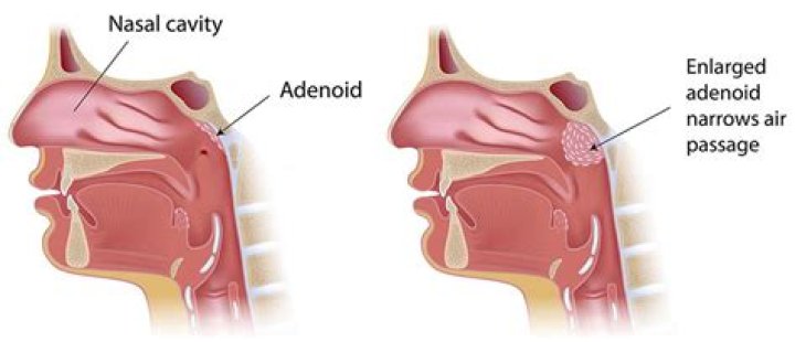 What is an adenectomy?