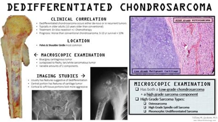 What is dedifferentiated chondrosarcoma?