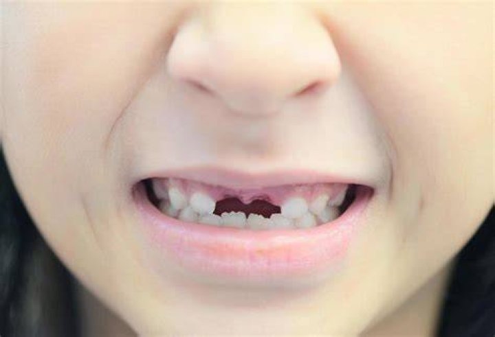 What is lost milk tooth?