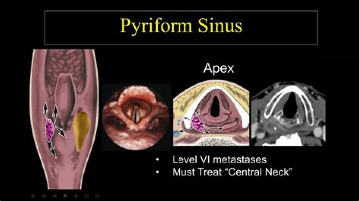 What is pyriform sinus?