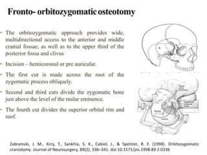 What is the orbitozygomatic approach?