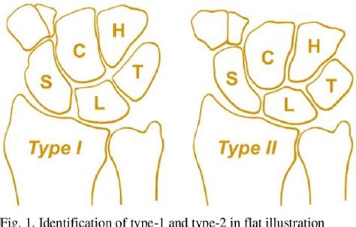 What is type 2 lunate?