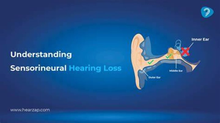 What sensorineural hearing loss sounds like?