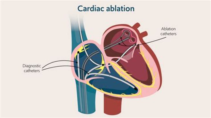 What us an ablation?