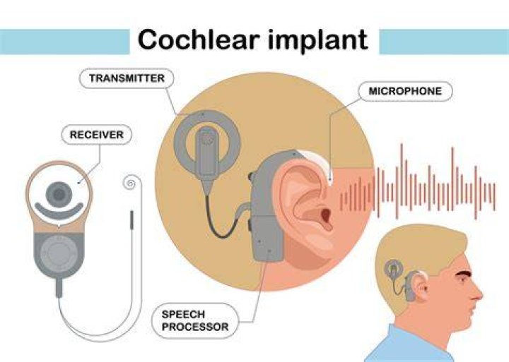 Whats does cochlear mean?