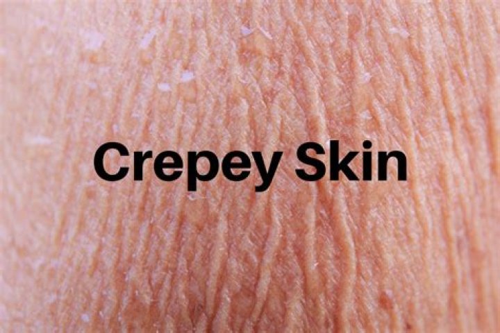 When does crepey skin start?
