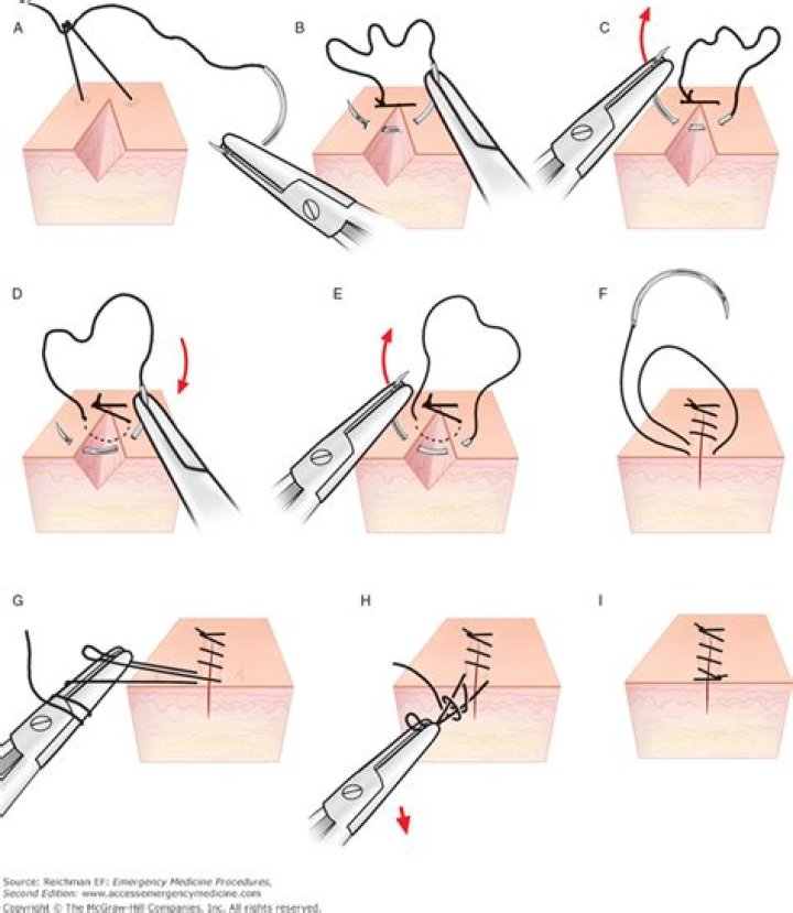 When should overriding sutures resolve?
