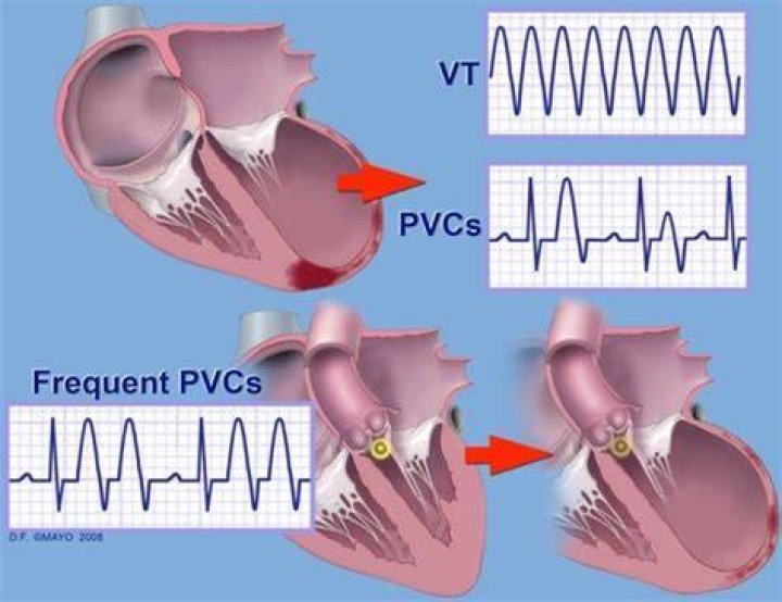 When to get an ablation for pvcs?