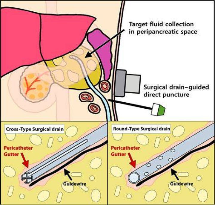 When to remove percutaneous drain?