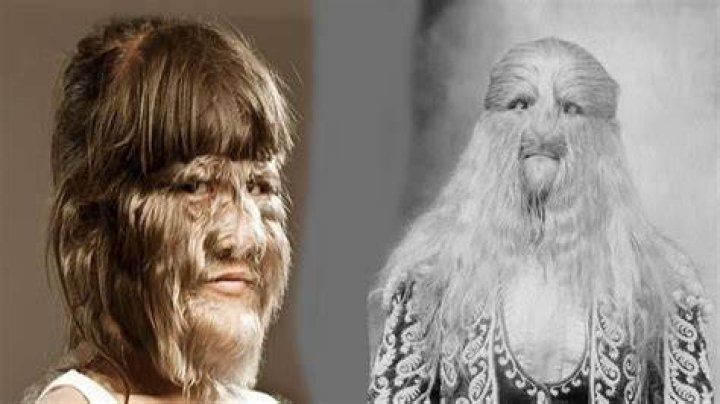 When was hypertrichosis first discovered?