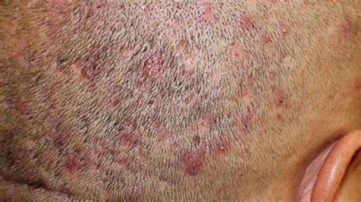 Where are scabs made?