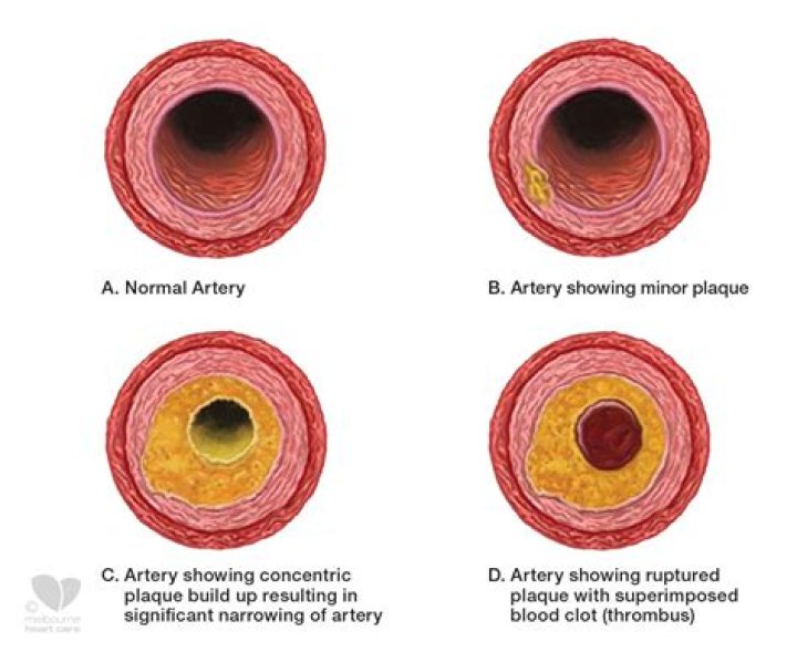 Where does plaque in arteries come from?