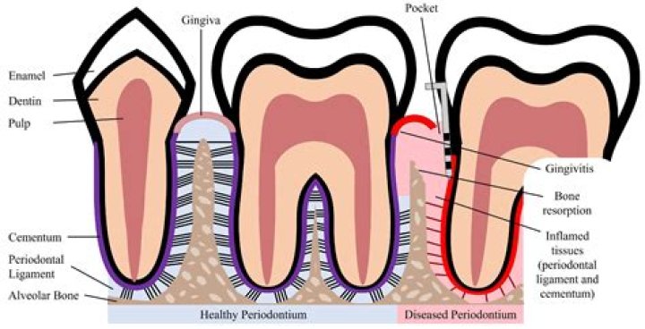 Where is periodontitis located?