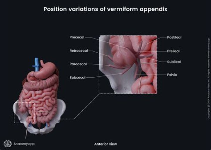 Where is the appendiceal located?